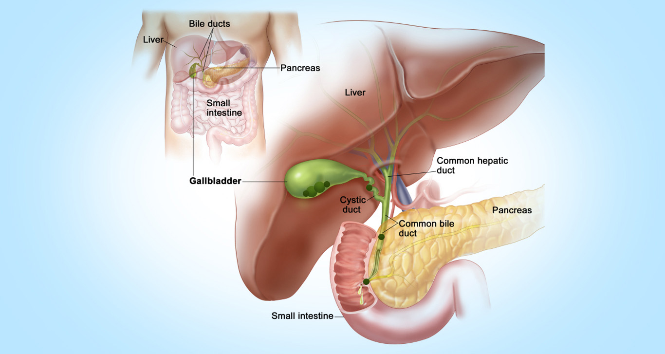 Treatment for Gallstones